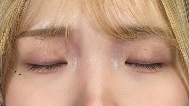 手術前の状態 その1