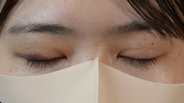 手术前的状态 其一