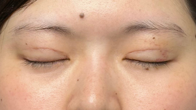 手术前的状态 其一