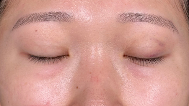 手術前の状態 その1