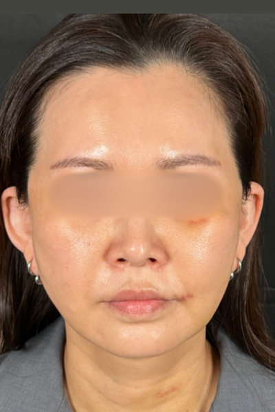 手术前的状态 其一