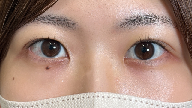 手术前的状态 其一