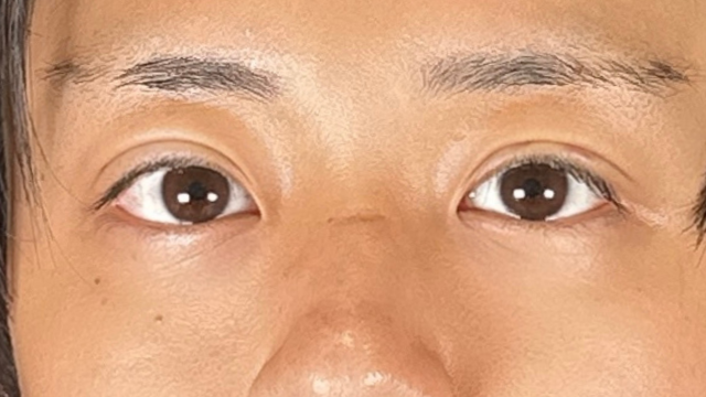 手术前的状态 其一