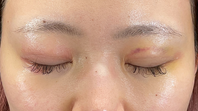 手术前的状态 其一