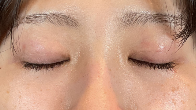 手术前的状态 其一