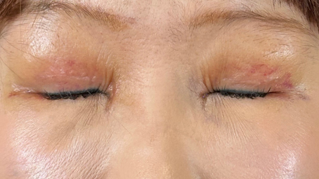 手术前的状态 其一