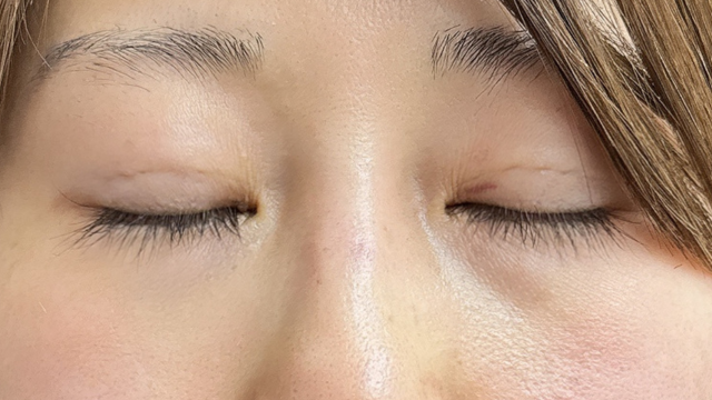 手术前的状态 其一