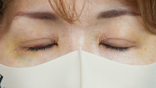 手術前の状態 その1