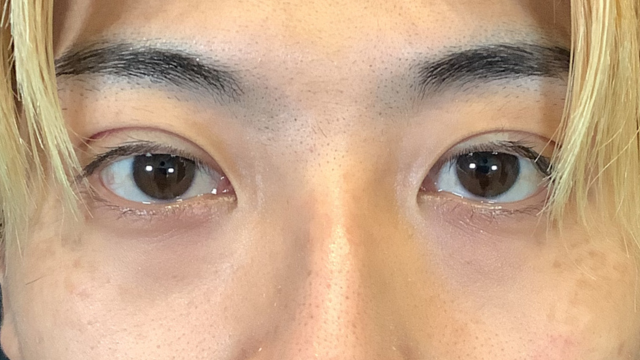 手术前的状态 其一