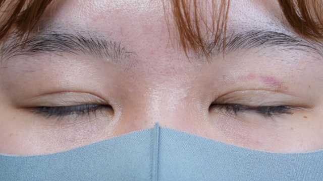 手术前的状态 其一