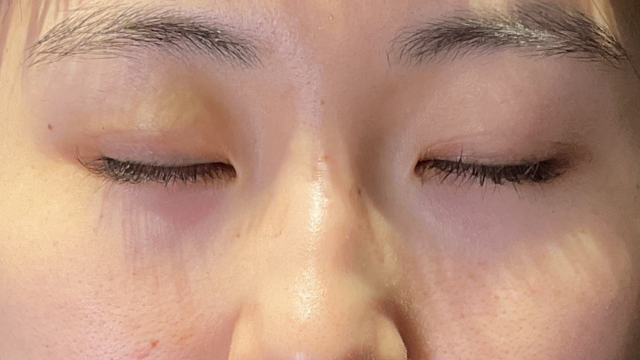 手术前的状态 其一