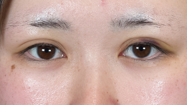 手術前の状態 その1