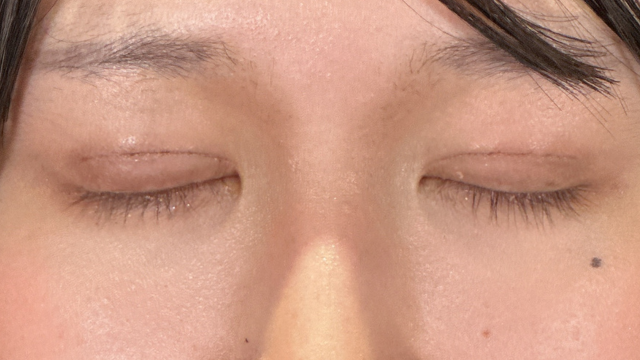 手术前的状态 其一