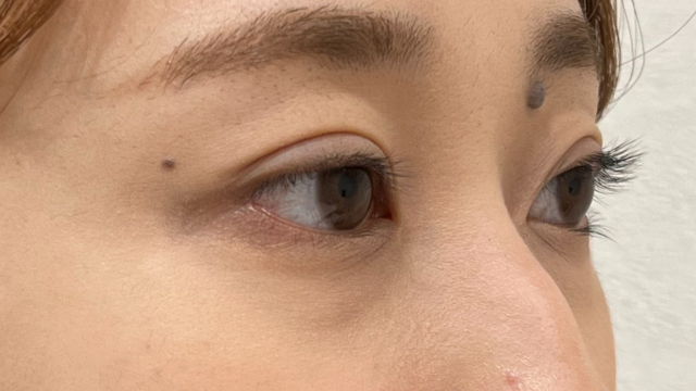 手术前的状态 其一