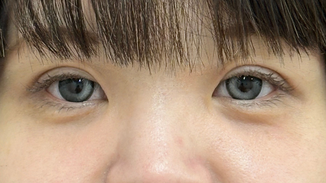 手術前の状態 その1