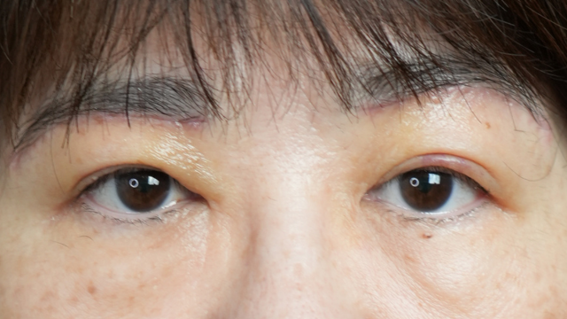 Postoperative Condition Part 1