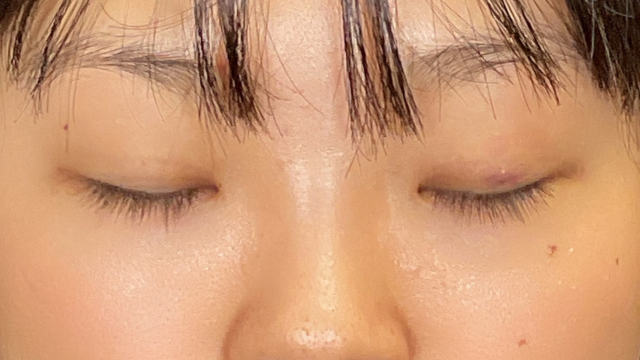 手術前の状態 その1