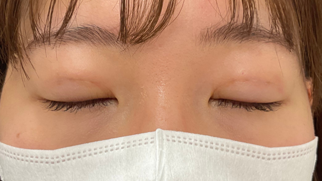 手术前的状态 其一