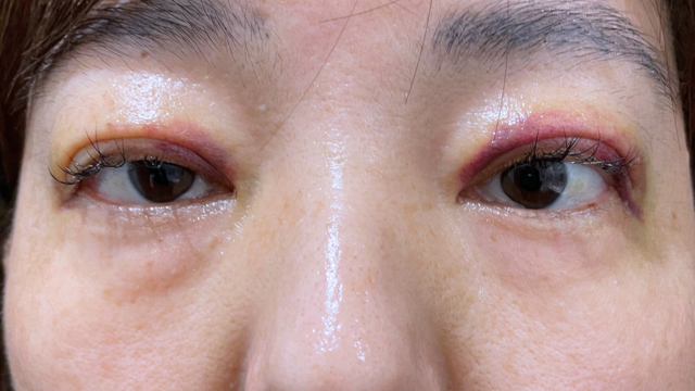 手術前の状態 その1