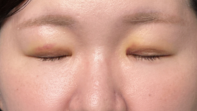 手术前的状态 其一