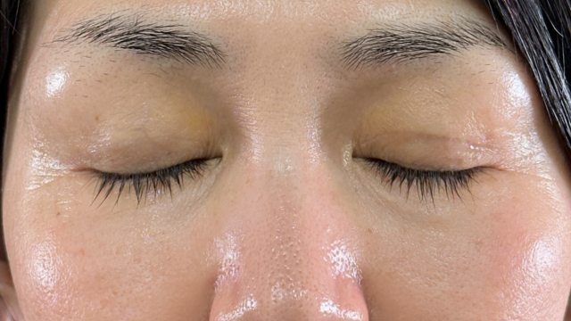 手术前的状态 其一