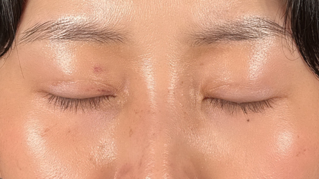 手术前的状态 其一