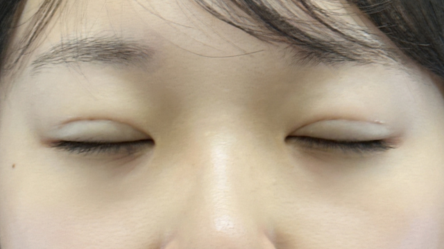 手术前的状态 其一