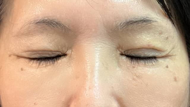 手術前の状態 その1