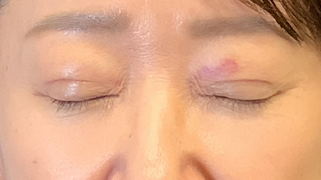 手術前の状態 その1