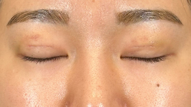 手術前の状態 その1