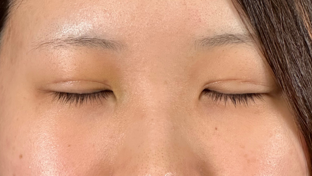 手术前的状态 其一