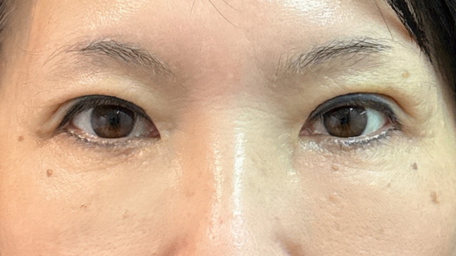 手術前の状態 その1