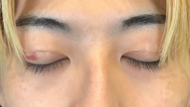 手术前的状态 其一