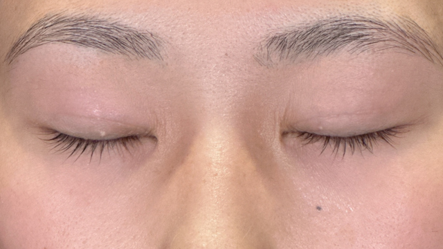 手術前の状態 その1