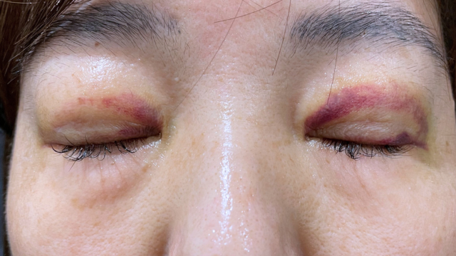 手術前の状態 その1