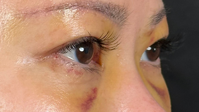 手术前的状态 其一