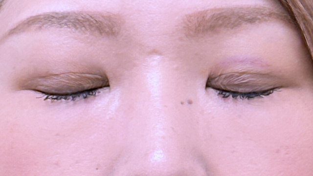 Postoperative Condition Part 1