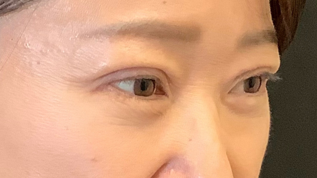 手術前の状態 その1