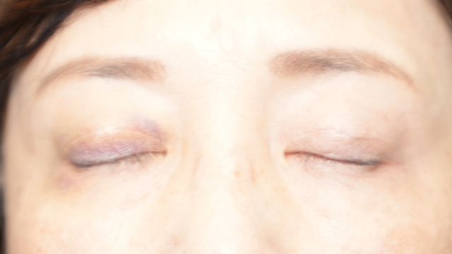 手術前の状態 その1