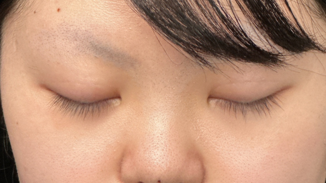 手术前的状态 其一