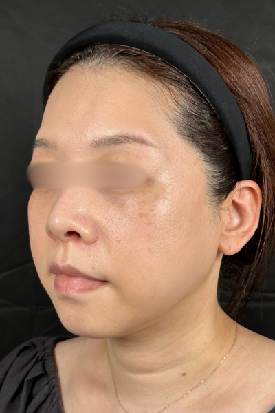 手術前の状態 その1