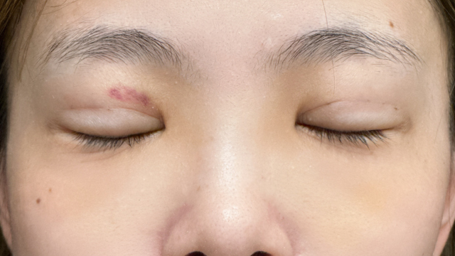 手术前的状态 其一