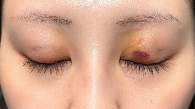 手术前的状态 其一