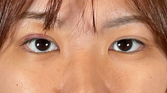 手术前的状态 其一