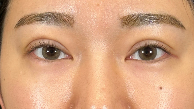 手術前の状態 その1