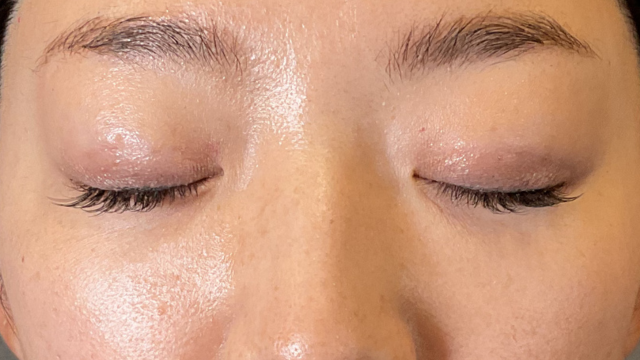 手术前的状态 其一