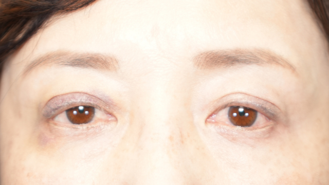 手術前の状態 その1