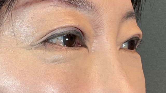 手術前の状態 その1