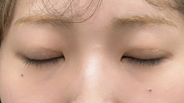 手术前的状态 其一