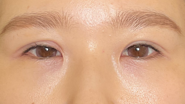 手术前的状态 其一